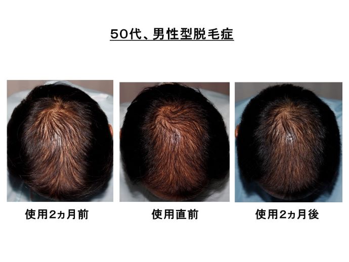 円形脱毛症　病院